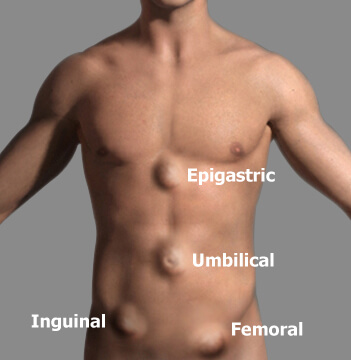 Hernia surgeon in navi mumbai